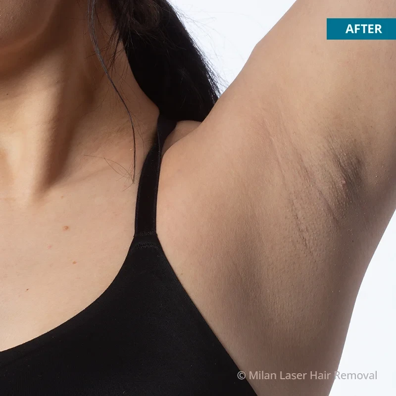 Underarm Hair Removal | Armpit Laser Hair Removal in Atlanta